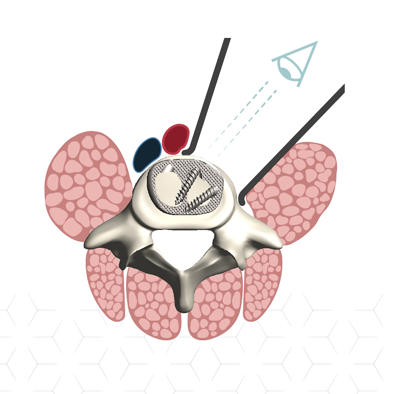 NovApproach Spine Custom Medical Illustrations design by Jenna Spencer