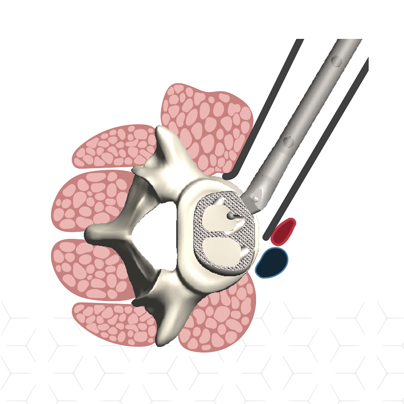 NovApproach Spine Custom Medical Illustrations design by Jenna Spencer