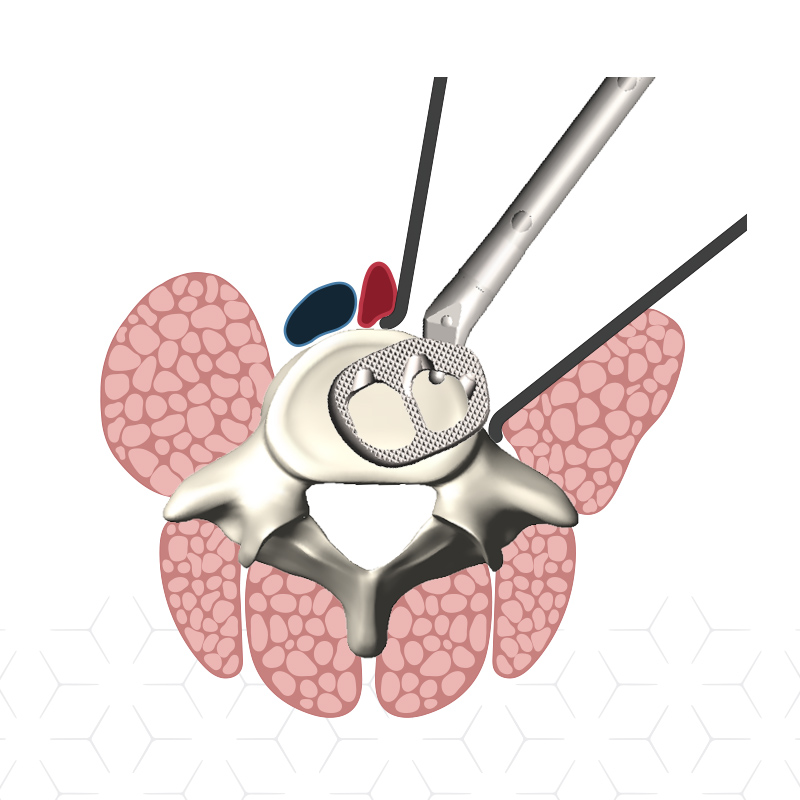 NovApproach Spine Custom Medical Illustrations design by Jenna Spencer
