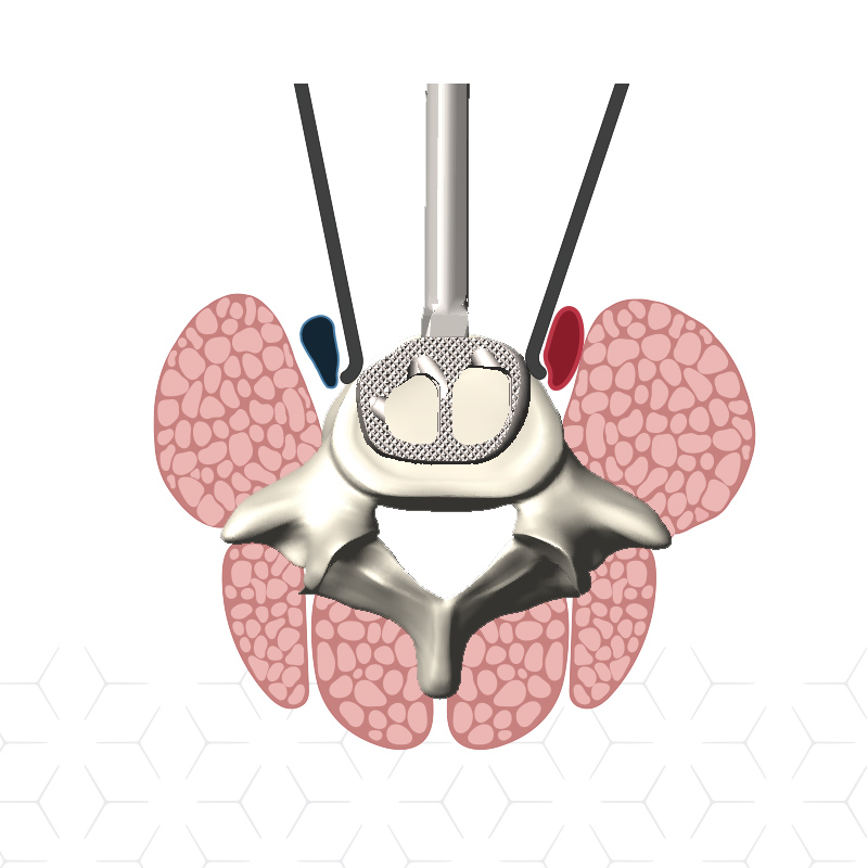 NovApproach Spine Custom Medical Illustrations design by Jenna Spencer